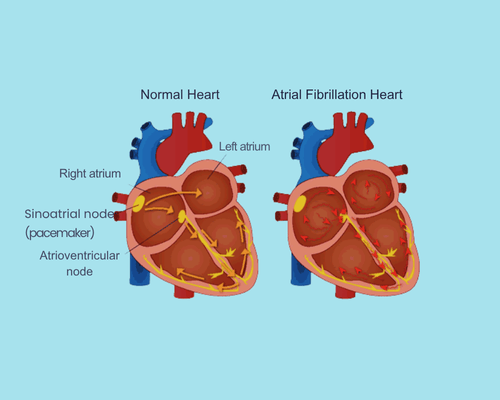 Normal Heart Vs Atrial Fibrillation